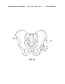 METHOD AND SYSTEM FOR ALIGNING A PROSTHESIS DURING SURGERY diagram and image