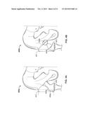 METHOD AND SYSTEM FOR ALIGNING A PROSTHESIS DURING SURGERY diagram and image