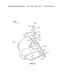 METHOD AND SYSTEM FOR ALIGNING A PROSTHESIS DURING SURGERY diagram and image