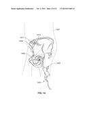 METHOD AND SYSTEM FOR ALIGNING A PROSTHESIS DURING SURGERY diagram and image