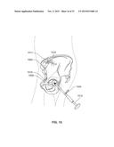 METHOD AND SYSTEM FOR ALIGNING A PROSTHESIS DURING SURGERY diagram and image