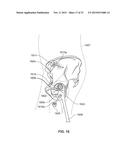 METHOD AND SYSTEM FOR ALIGNING A PROSTHESIS DURING SURGERY diagram and image