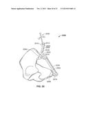 METHOD AND SYSTEM FOR ALIGNING A PROSTHESIS DURING SURGERY diagram and image