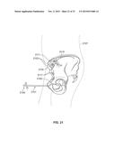 METHOD AND SYSTEM FOR ALIGNING A PROSTHESIS DURING SURGERY diagram and image