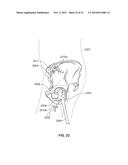 METHOD AND SYSTEM FOR ALIGNING A PROSTHESIS DURING SURGERY diagram and image