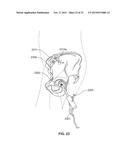 METHOD AND SYSTEM FOR ALIGNING A PROSTHESIS DURING SURGERY diagram and image