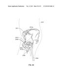 METHOD AND SYSTEM FOR ALIGNING A PROSTHESIS DURING SURGERY diagram and image