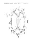 VALVE PROSTHESIS diagram and image