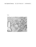 Diagnostic Biomarkers and Therapeutic Targets for Pancreatic Cancer diagram and image