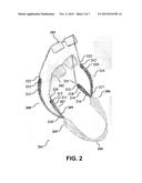 Eyeglass Retention Device diagram and image