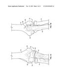 Patient-Specific Elbow Guides And Associated Methods diagram and image