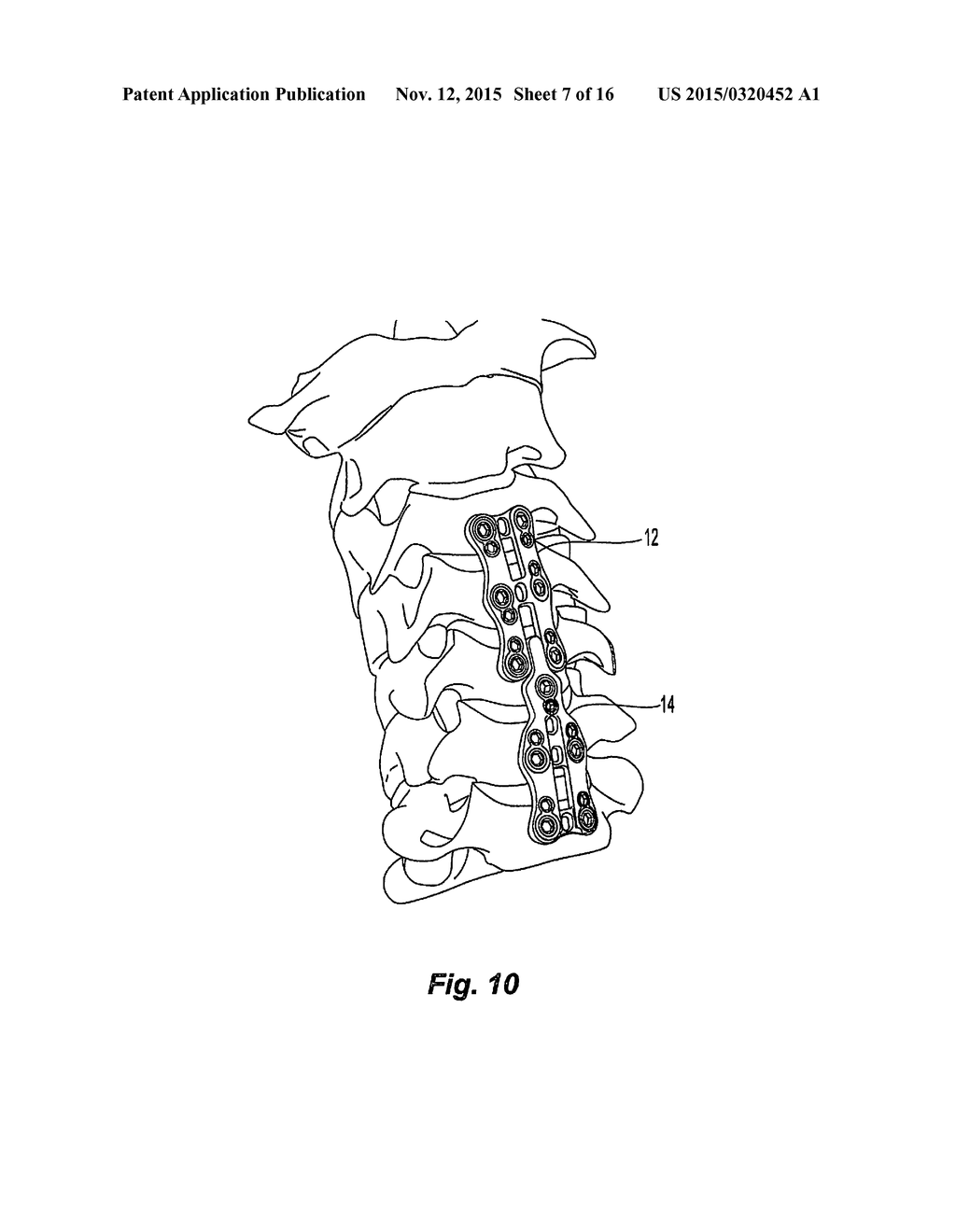 CERVICAL SPINE STABILIZATION SYSTEM WITH EXTENDABLE PLATES - diagram, schematic, and image 08