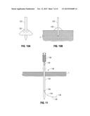 ABLATION PROBE FIXATION diagram and image