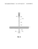 ABLATION PROBE FIXATION diagram and image