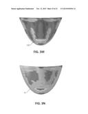 REPLACEMENT HEART VALVES AND THEIR METHODS OF USE AND MANUFACTURE diagram and image