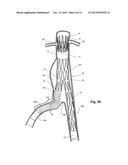 FLEXIBLE STENT GRAFT diagram and image