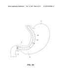 SATIATION DEVICES AND METHODS diagram and image