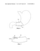 SATIATION DEVICES AND METHODS diagram and image