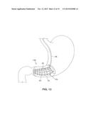 SATIATION DEVICES AND METHODS diagram and image