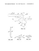 Lens Nucleus Chopper diagram and image