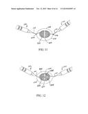 Lens Nucleus Chopper diagram and image