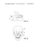 BONE IMPLANT AND SYSTEMS THAT CONTROLLABLY RELEASES SILVER diagram and image