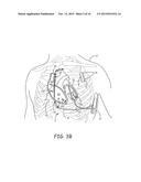 ACOUSTICALLY TRIGGERED THERAPY DELIVERY diagram and image