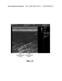 METHOD AND SYSTEM OF ASSESSING OR ANALYZING MUSCLE CHARACTERISTICS     INCLUDING STRENGTH AND TENDERNESS USING ULTRASOUND diagram and image