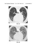 AUTOMATED IMAGE SYSTEM FOR SCORING CHANGES IN QUANTITATIVE INTERSTITIAL     LUNG DISEASE diagram and image