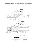 SELF-CLOSING DEVICES AND METHODS FOR MAKING AND USING THEM diagram and image