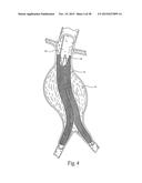 Surgical Fastener Assembly for Attaching a Prosthesis diagram and image