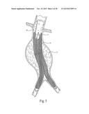 Surgical Fastener Assembly for Attaching a Prosthesis diagram and image