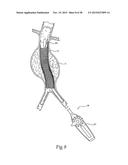 Surgical Fastener Assembly for Attaching a Prosthesis diagram and image