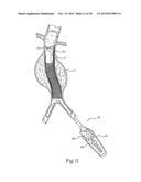 Surgical Fastener Assembly for Attaching a Prosthesis diagram and image