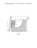 Surgical Fastener Assembly for Attaching a Prosthesis diagram and image