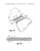 DETACHABLE BUTTRESS MATERIAL RETENTION SYSTEMS FOR USE WITH A SURGICAL     STAPLING DEVICE diagram and image