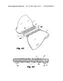 DETACHABLE BUTTRESS MATERIAL RETENTION SYSTEMS FOR USE WITH A SURGICAL     STAPLING DEVICE diagram and image