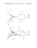 DEVICES, SYSTEMS AND METHODS FOR ENCLOSING AN ANATOMICAL OPENING diagram and image