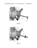 METHOD OF PERFORMING SACROILIAC FUSION diagram and image