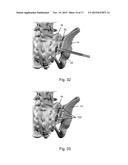 METHOD OF PERFORMING SACROILIAC FUSION diagram and image