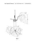 PEDICLE DRILL GUIDE FOR SPINAL SURGERY diagram and image