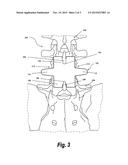 SPINAL GRAFT diagram and image