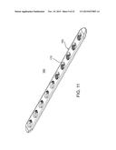 COMPOSITE MATERIAL BONE IMPLANT diagram and image