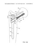 COMPOSITE MATERIAL BONE IMPLANT diagram and image