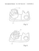 Occipital Plates with Mesh Portions diagram and image