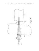 BONE SCREW diagram and image