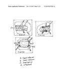 DENTAL APPLIANCE TO PREVENT MASTICATION diagram and image