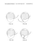 SOFT TISSUE AUGMENTATION THREADS AND METHODS OF USE THEREOF diagram and image