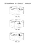 SOFT TISSUE AUGMENTATION THREADS AND METHODS OF USE THEREOF diagram and image