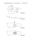 SOFT TISSUE AUGMENTATION THREADS AND METHODS OF USE THEREOF diagram and image